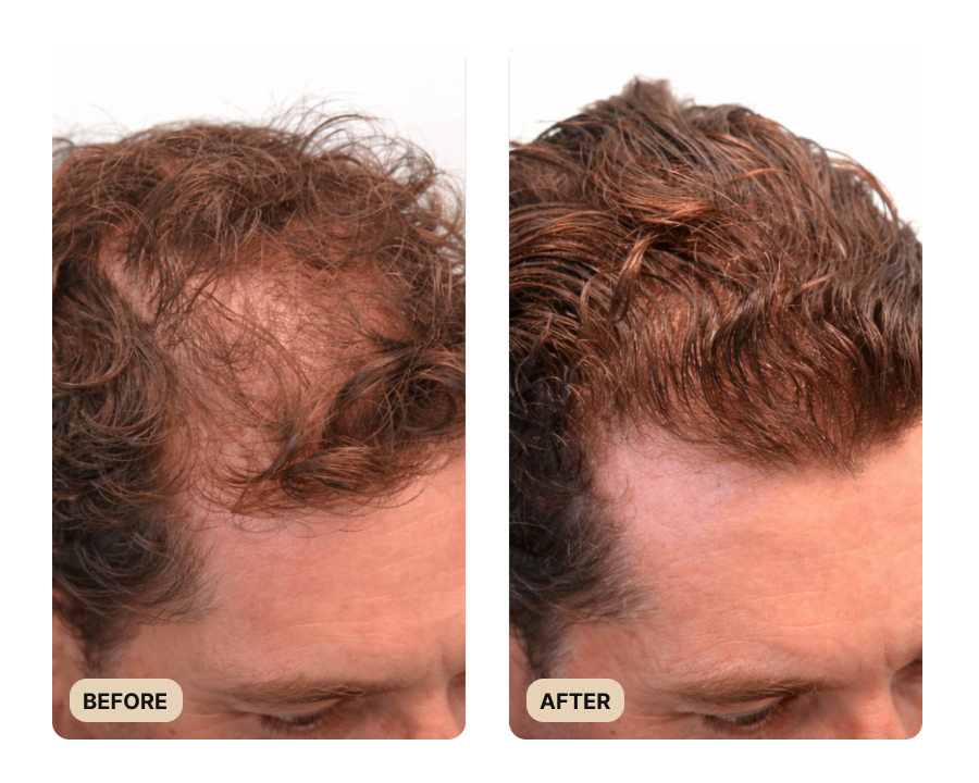 Full Hair Growth System