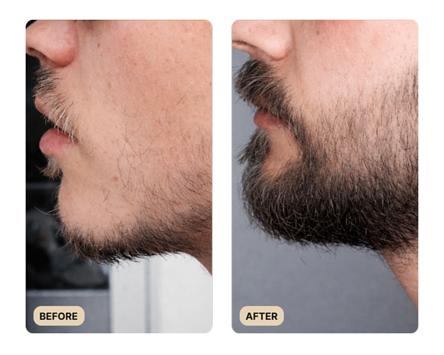 Full Beard Growth System