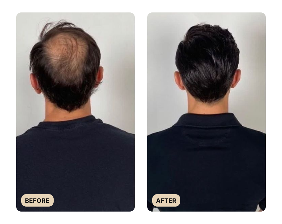 Full Hair Growth System
