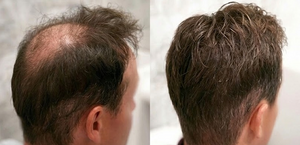 Visible Hair Regrowth Results