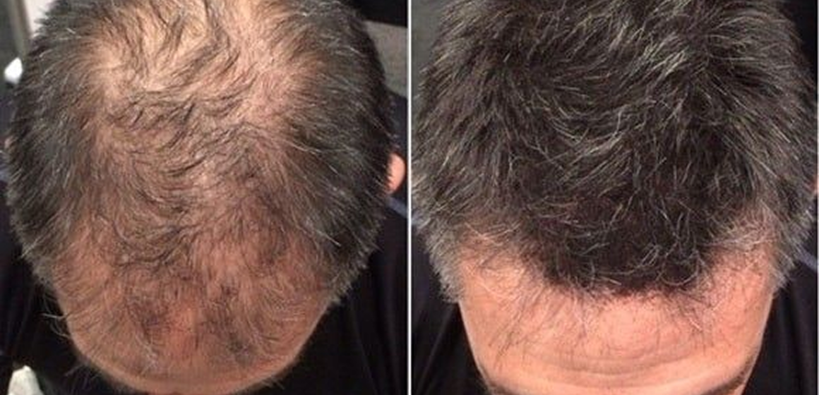 Visible Hair Regrowth Results