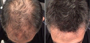 Visible Hair Regrowth Results