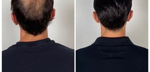 Visible Hair Regrowth Results