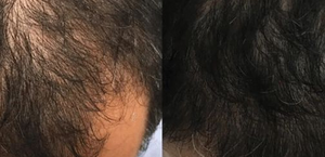 Visible Hair Regrowth Results